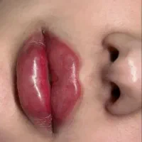 خدمات ژل و بوتاکس میکرو‌ نیدیلینگ و پلکسر