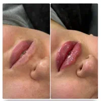 جوانسازی روشن سازی و حجم دهی بیکنی