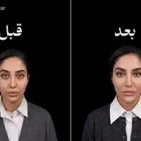 تزریق فیلر فول فیس کاملا رایگان