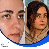 جراحی با پیزوسرجری برای شمالی های عزیز