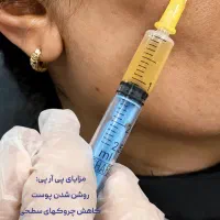 پی آر پی هیرفیلر ریزش مو توسط پزشک PRP پی آر اف