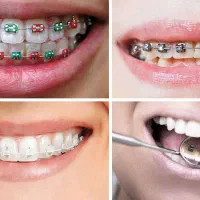 ارتودنسی ، ایمپلنت اقساط