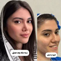 جراحی بینی،شروع زیبایی با ۵۰درصد تخفیف در تهران