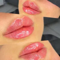 ژل لب  /طبیعی /روسی/نچرال/تزریق فقط توسط دکتر