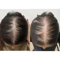 قطع ریزش مو و رویش مجدد مو