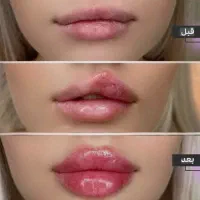 آموزش ژل بوتاکس