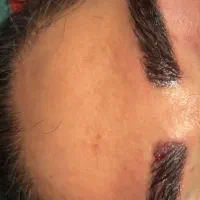 کاشت ایرو در کلینیک معتبر