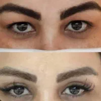تخفیف ویژه محرم بلفاروپلاستی چشم هشت میلیون