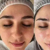 تخفیف تابستانه  پدیکورتراپی جوانسازی فیشیال