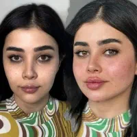 آموزش و تزریق ژل و بوتاکس،تزریق چربی،لیفت نخ