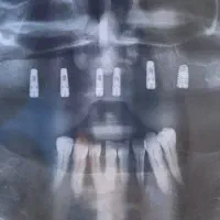 ارتودنسی و ایمپلنت دندان