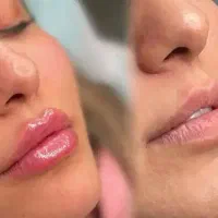 ژل لب کانتورینگ مزوژل لیفت صورت
