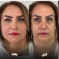 جشنواره بهاره لیفت هایفو با لیزر و ۱۰ هدیه رایگان