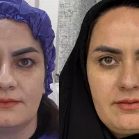 جشنواره بلفاروپلاستی زیبایی چشم بوکال فت ( اقساط )