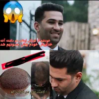 کاشت مو و ابرو