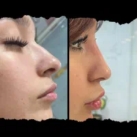 ژل لب . آنزیم بینی . زاویه سازی