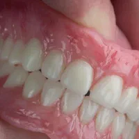 دندان مصنوعی / ارتودنسی نامرئی/نگهدارنده ارتودنسی