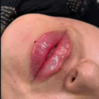 تزریق ژل بوتاکس فیلر