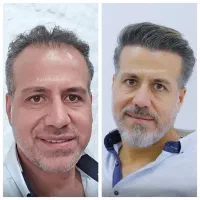 کاشت مو با تعرفه ی دولتی