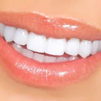 ارتودنسی،کامپوزیت، لمینت،ایمپلنت