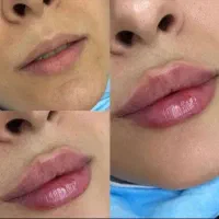 تزریق بوتاکس و فیلر در مطب پزشک