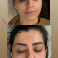 فیلروبوتاکس