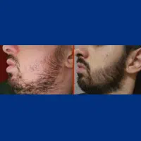 زیر دو ماه مو و ریشتو جنگل کن