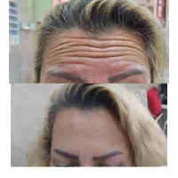 خدمات بوتاکس/مصپورت/ فقط و فقط  نهصد و پنجاه