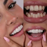 کامپوزیت/لمینت/دندانپزشکی