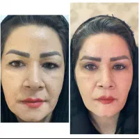 بلفاروپلاستی فقط۱۰میلیون