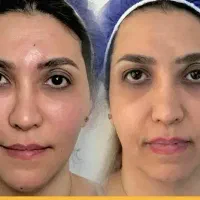 بوتاکس ۴۵۰ ژل ۸۵۰