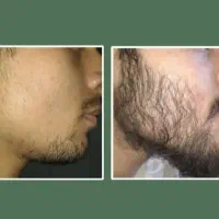 تقویت ریش طی ۳۰ روز