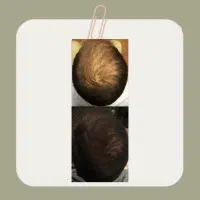 بدون نیاز به کاشت