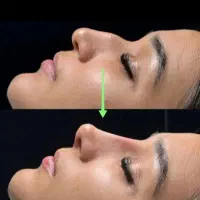 کوچک کردن بینی و فرم دهی در کمترین زمان ممکن