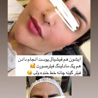 جشنواره فیلر  صورت لب گونه چانه از سی سی۷۰۰