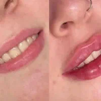 جشنواره تزریق و آموزش ژل بوتاکس مزوژل در کلینیک