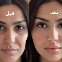 جشنواره ژل بوتاکس فیلر  پی ار پی در مطب زیبایی