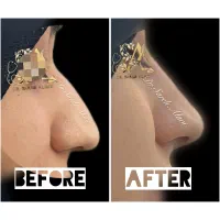 فرم دهی بینی بدون جراحی توسط پزشک