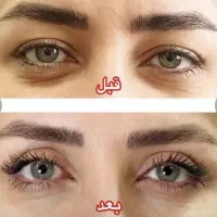 جشنواره بلفاروپلاستی (جراحی پلک)