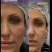 ژل،بوتاکس،فیلربادی،بیکینی،زاویه سازبدون درد وکبودی