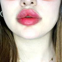 ژل وبوتاکس
