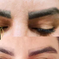 ریموو تاتو ابرو ، چشم و لب و رویش مجددموی سر وابرو