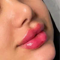 فیلر با تکنیک های روز کره ای