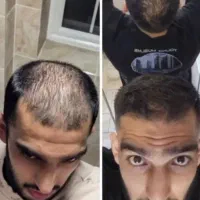 راز پرپشتی بدون کاشت رو میخوای بدونی پیام بده