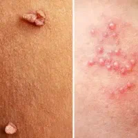 بازگشت به زندگی سالم/ با درمان قطعی زگیل