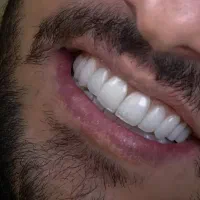 کامپوزیت لمینت فیسنیگ دندانپزشکی شیراز ضمانت کتبی