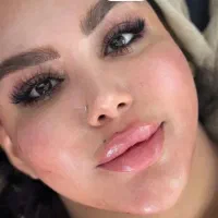 فیلر لب و انزیم و بوتاکس