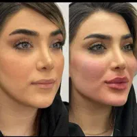 تخفیف ژل و بوتاکس و نخ و جوانساز در کیلینیک