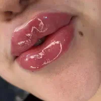 تزریق ژل(فیلر)و بوتاکس و فول فیس «توسط پزشک »