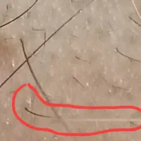 درمان ریزش و سفید شدن مو و رویش مجدد